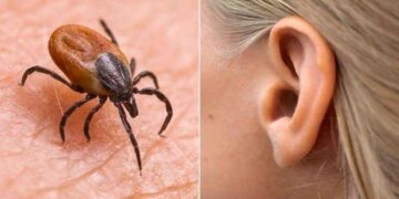 Disturbing: A Woman’s Mysterious Ear Pain Turns Out to Be a Tick.